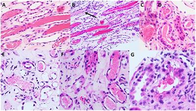 Acute kidney injury and ANCA positivity in a patient treated with glecaprevir/pibrentasvir: a case report